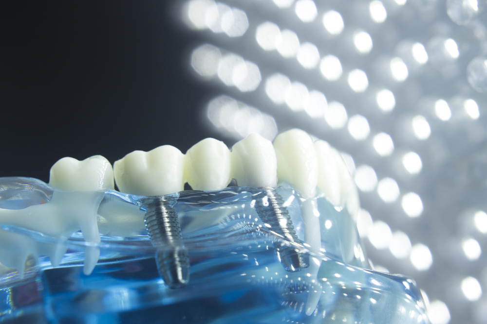 How Long Does Dental Implant Surgery Take